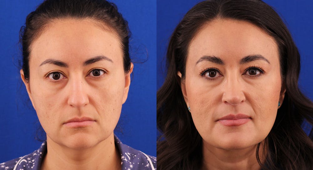 Rhinoplasty Before & After Gallery - Patient 109674 - Image 3