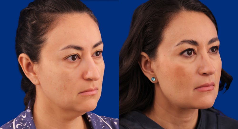 Rhinoplasty Before & After Gallery - Patient 109674 - Image 2