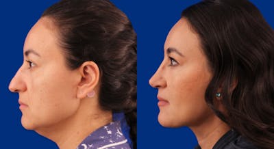 Rhinoplasty Before & After Gallery - Patient 109674 - Image 1
