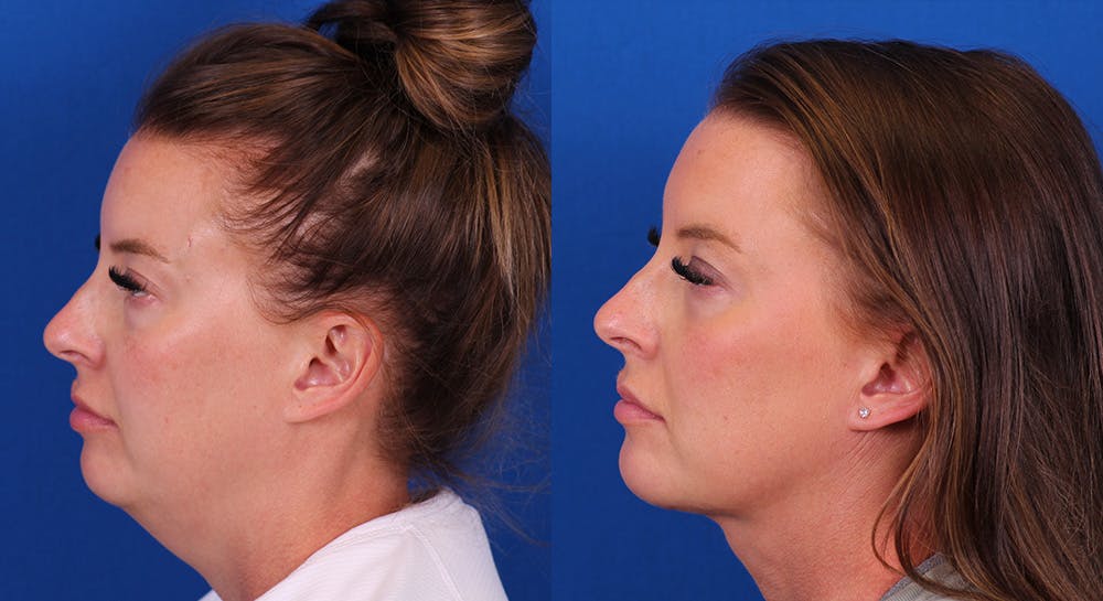 Neck deFINE Before & After Gallery - Patient 126775 - Image 1