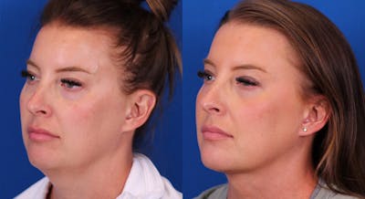 Neck deFINE Before & After Gallery - Patient 126775 - Image 2