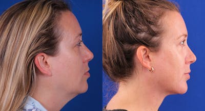 Neck deFINE Before & After Gallery - Patient 141442 - Image 1