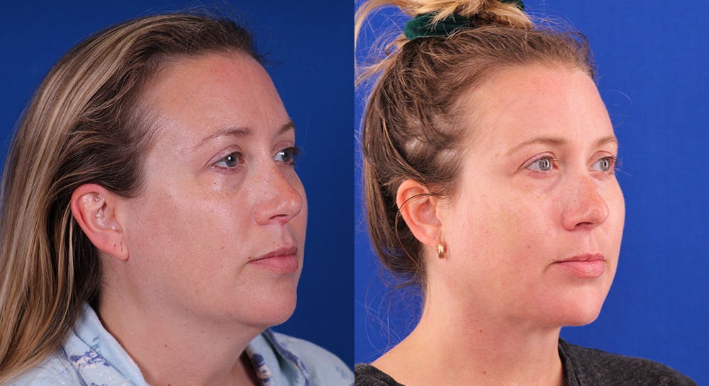 Neck deFINE Before & After Gallery - Patient 141442 - Image 2