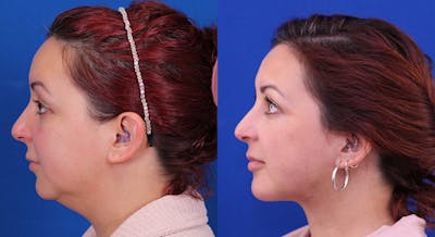 Neck deFINE Before & After Gallery - Patient 282194 - Image 1