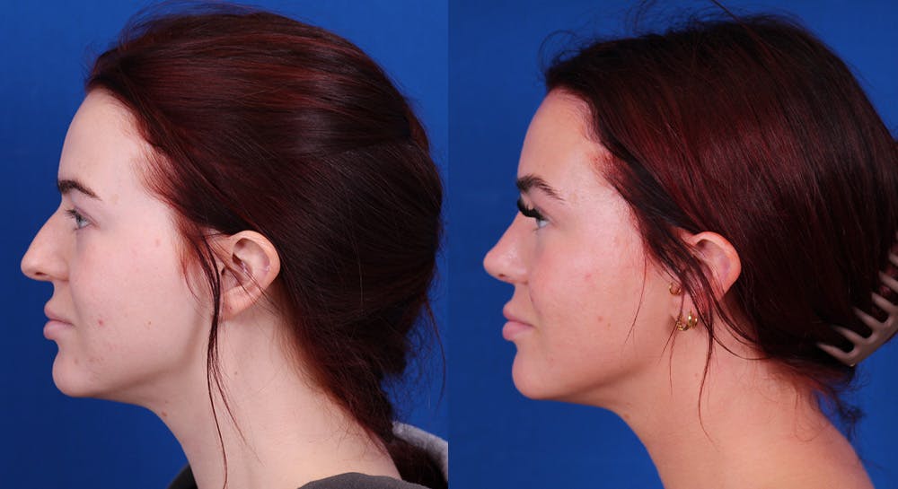 Rhinoplasty Before & After Gallery - Patient 163556 - Image 1