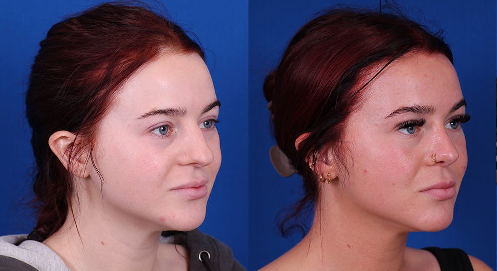 Rhinoplasty Before & After Gallery - Patient 163556 - Image 2