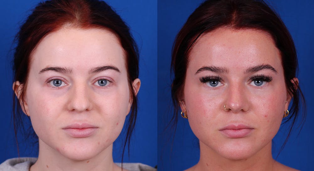 Rhinoplasty Before & After Gallery - Patient 163556 - Image 3