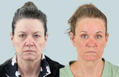 Blepharoplasty Before & After Gallery - Patient 302741 - Image 1