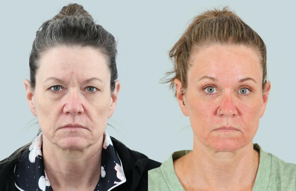 Blepharoplasty Before & After Gallery - Patient 302741 - Image 1