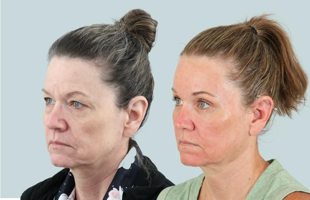 Blepharoplasty Before & After Gallery - Patient 302741 - Image 3