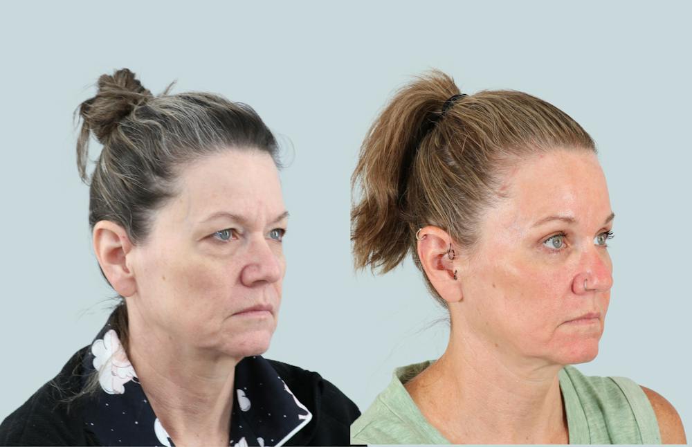Blepharoplasty Before & After Gallery - Patient 302741 - Image 2