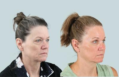 Blepharoplasty Before & After Gallery - Patient 302741 - Image 2