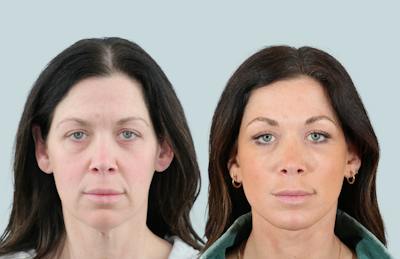 Facelift/Neck Lift Before & After Gallery - Patient 240418 - Image 1