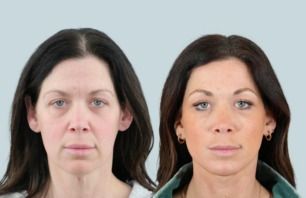 Facelift/Neck Lift Before & After Gallery - Patient 240418 - Image 1