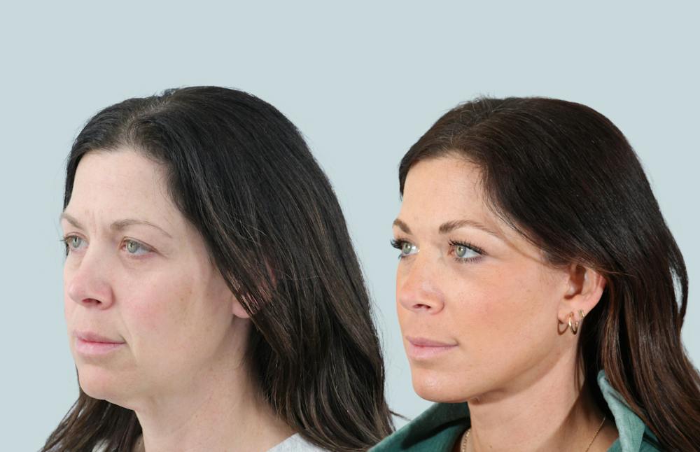Facelift/Neck Lift Before & After Gallery - Patient 240418 - Image 3