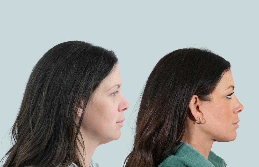 Facelift/Neck Lift Before & After Gallery - Patient 240418 - Image 2
