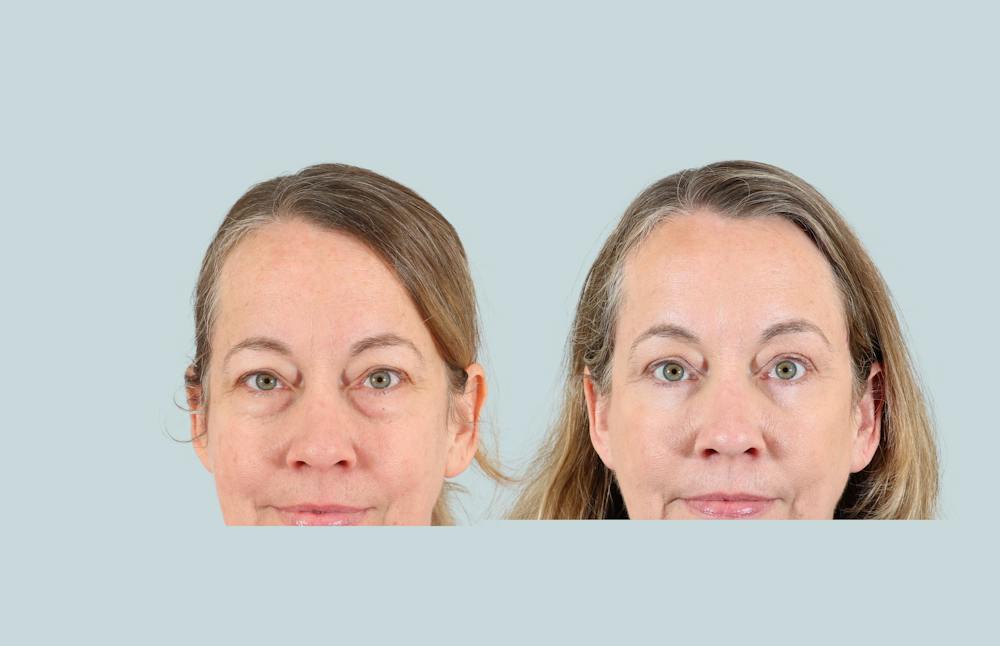 Blepharoplasty Before & After Gallery - Patient 194839 - Image 1