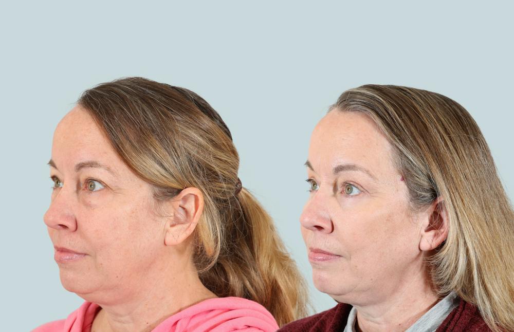 Blepharoplasty Before & After Gallery - Patient 194839 - Image 3