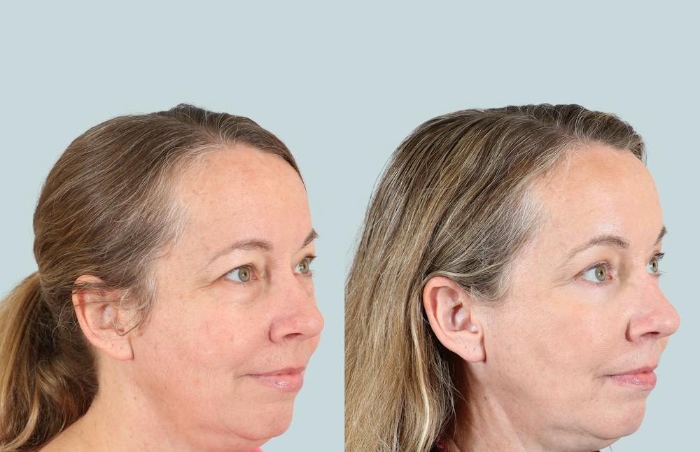Blepharoplasty Before & After Gallery - Patient 194839 - Image 2