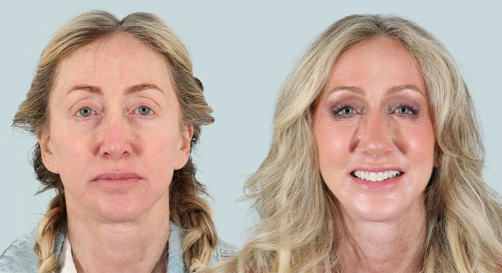 Rhinoplasty Before & After Gallery - Patient 279251 - Image 2