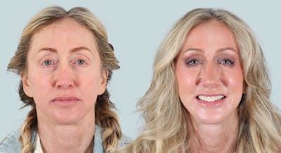 Rhinoplasty Before & After Gallery - Patient 279251 - Image 2