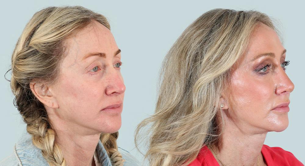 Rhinoplasty Before & After Gallery - Patient 279251 - Image 3