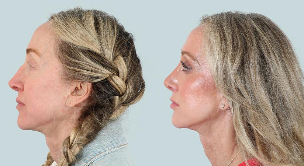 Rhinoplasty Before & After Gallery - Patient 279251 - Image 1