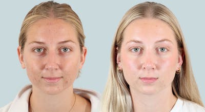Rhinoplasty Before & After Gallery - Patient 124291 - Image 2