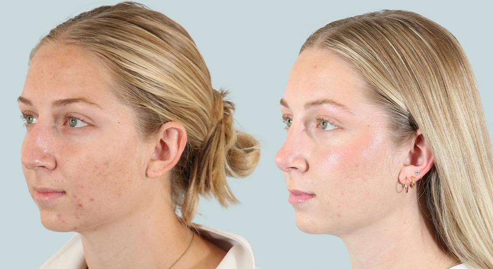 Rhinoplasty Before & After Gallery - Patient 124291 - Image 3