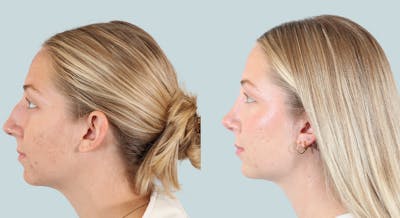 Rhinoplasty Before & After Gallery - Patient 124291 - Image 1