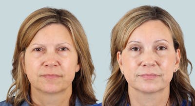Blepharoplasty Before & After Gallery - Patient 421620 - Image 1