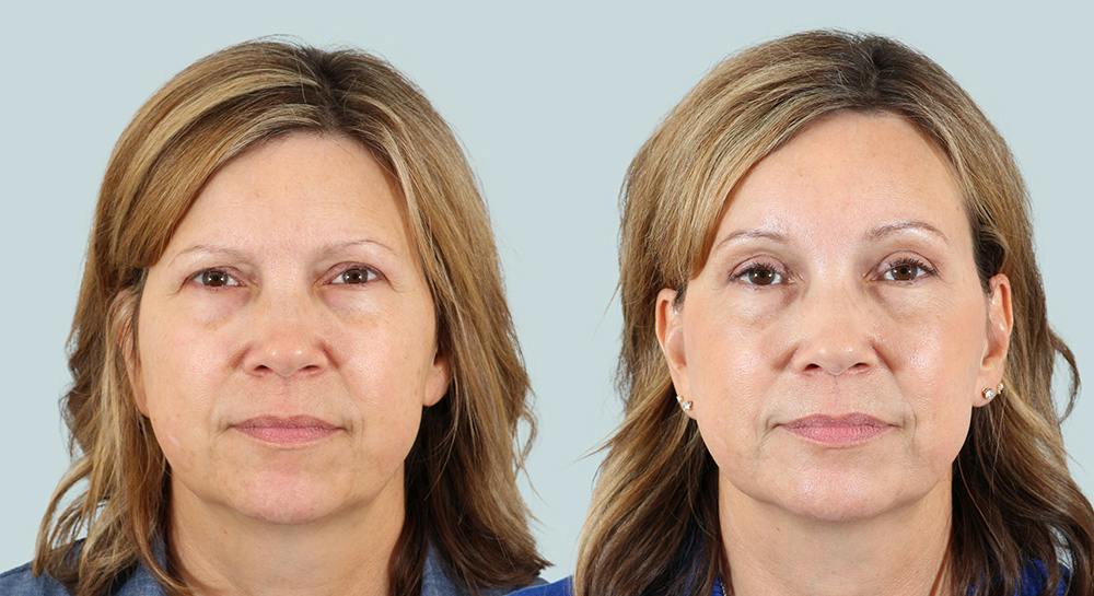 Blepharoplasty Before & After Gallery - Patient 421620 - Image 1