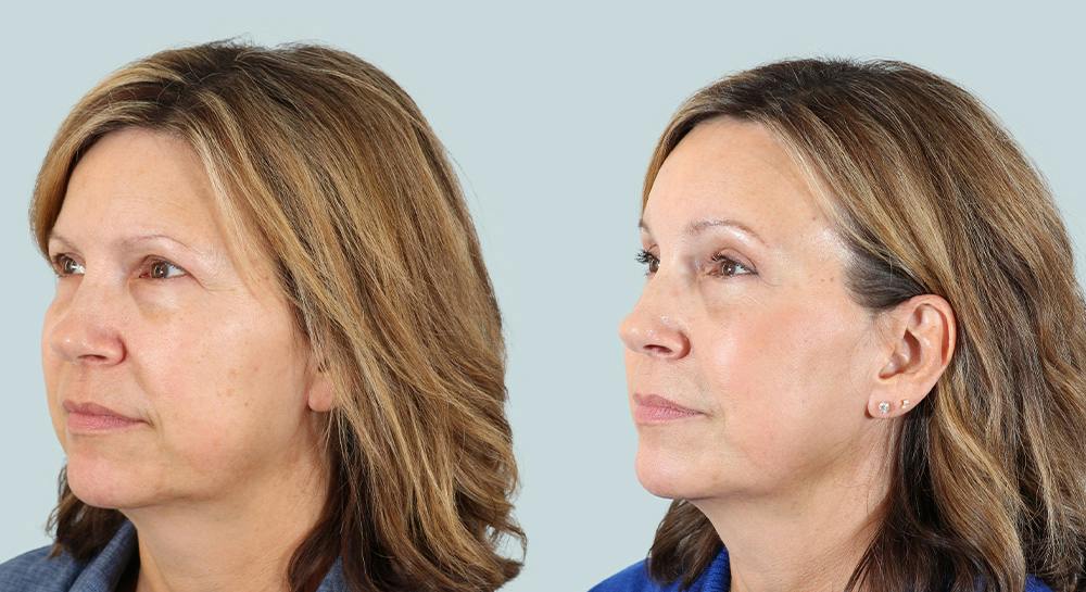 Blepharoplasty Before & After Gallery - Patient 421620 - Image 3