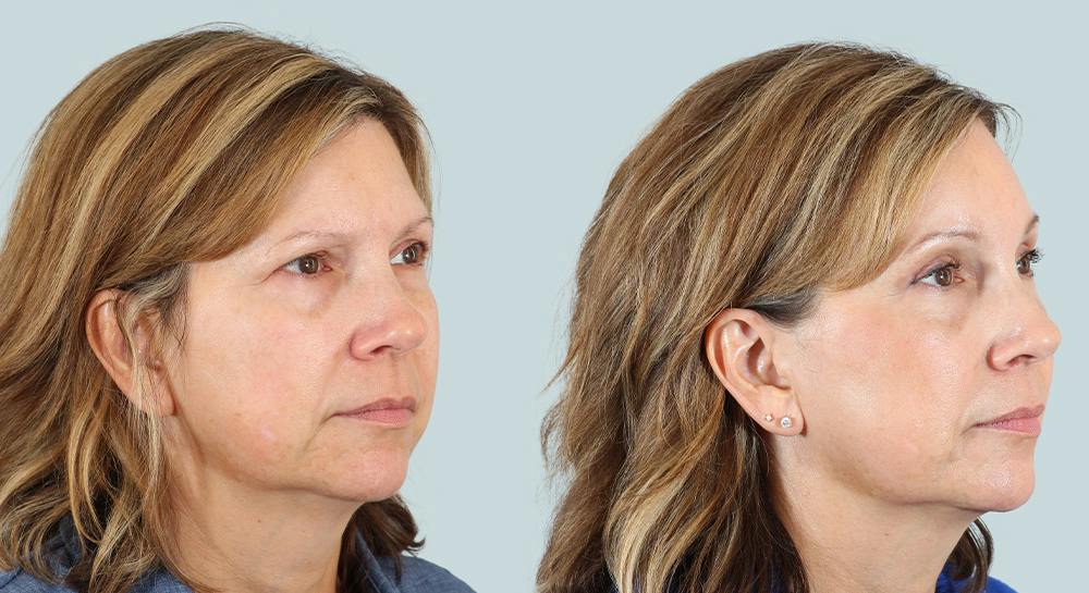 Blepharoplasty Before & After Gallery - Patient 421620 - Image 2