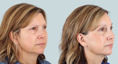 Blepharoplasty Before & After Gallery - Patient 421620 - Image 2