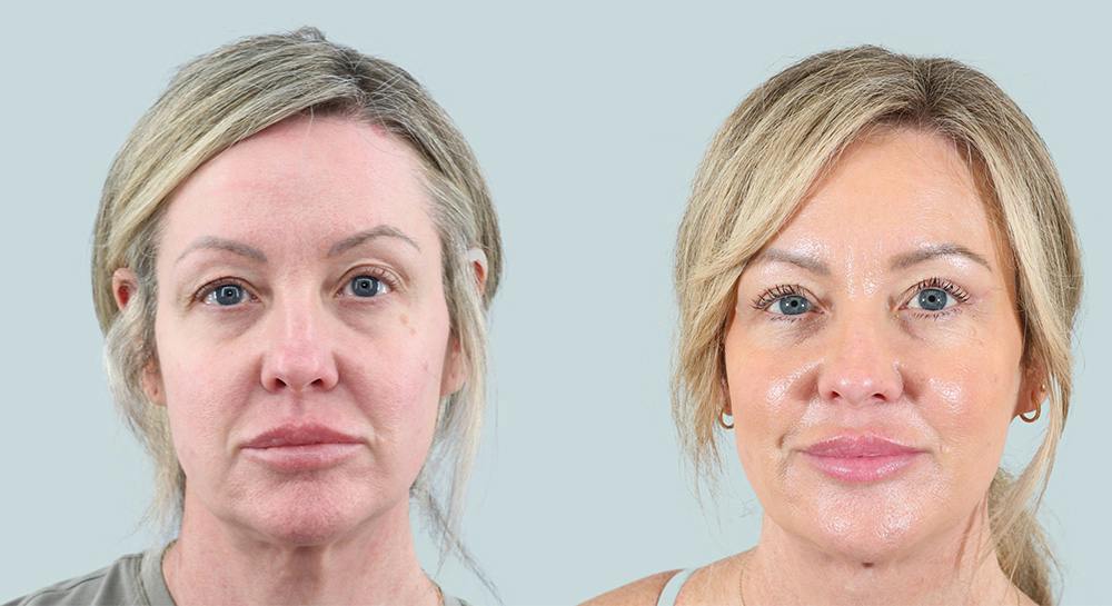 Blepharoplasty Before & After Gallery - Patient 101283 - Image 1