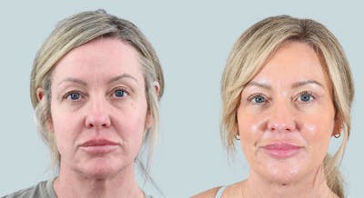 Blepharoplasty Before & After Gallery - Patient 101283 - Image 1