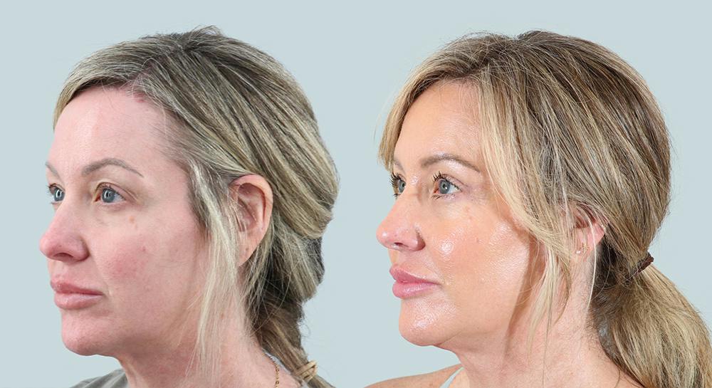 Blepharoplasty Before & After Gallery - Patient 101283 - Image 3