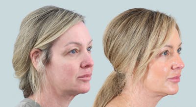 Blepharoplasty Before & After Gallery - Patient 101283 - Image 2