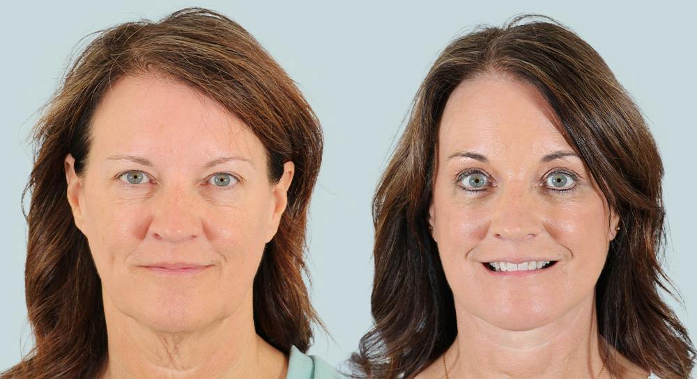 Brow Lift Before & After Gallery - Patient 156037 - Image 1