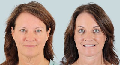 Blepharoplasty Before & After Gallery - Patient 305227 - Image 1