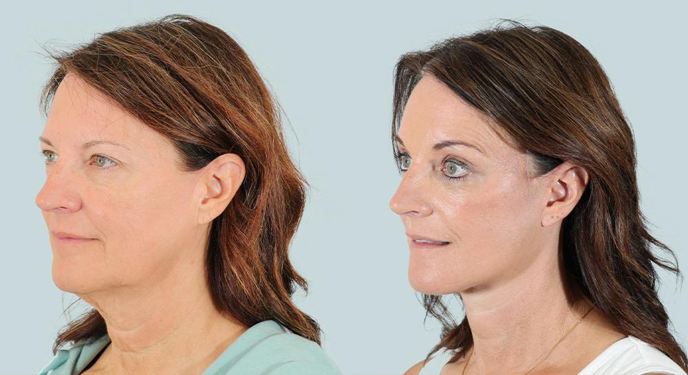 Brow Lift Before & After Gallery - Patient 156037 - Image 2