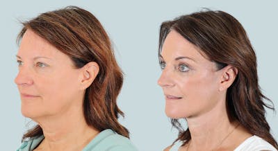 Brow Lift Before & After Gallery - Patient 156037 - Image 2
