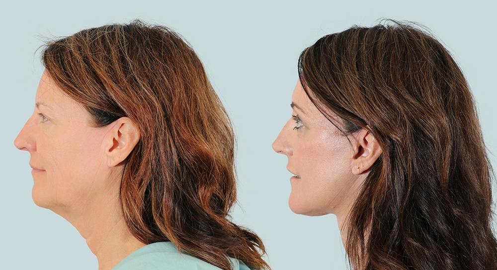 Brow Lift Before & After Gallery - Patient 156037 - Image 3