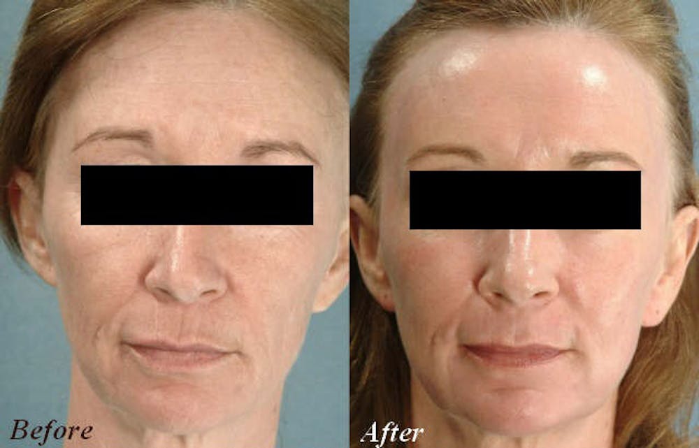 Active FX Before & After Gallery - Patient 24560254 - Image 1
