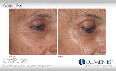 Active FX Before & After Gallery - Patient 24560259 - Image 1