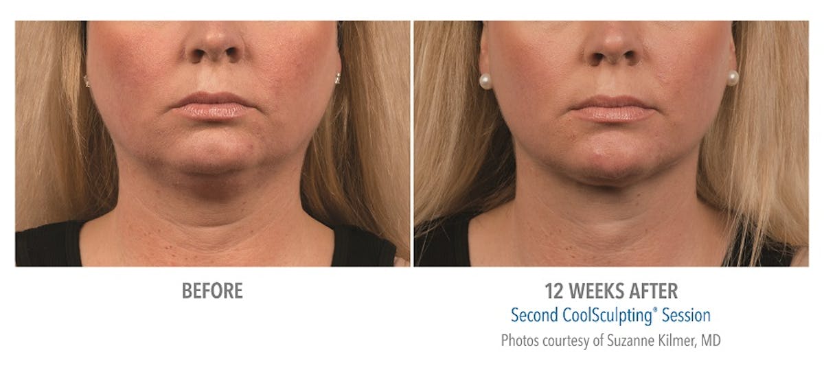 CoolMini Before & After Gallery - Patient 24560426 - Image 1