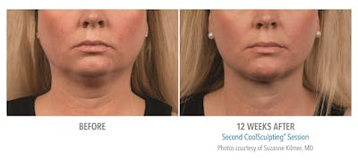 CoolMini Before & After Gallery - Patient 24560426 - Image 1