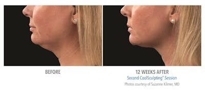 CoolMini Before & After Gallery - Patient 24560426 - Image 2