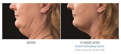 CoolMini Before & After Gallery - Patient 24560427 - Image 1
